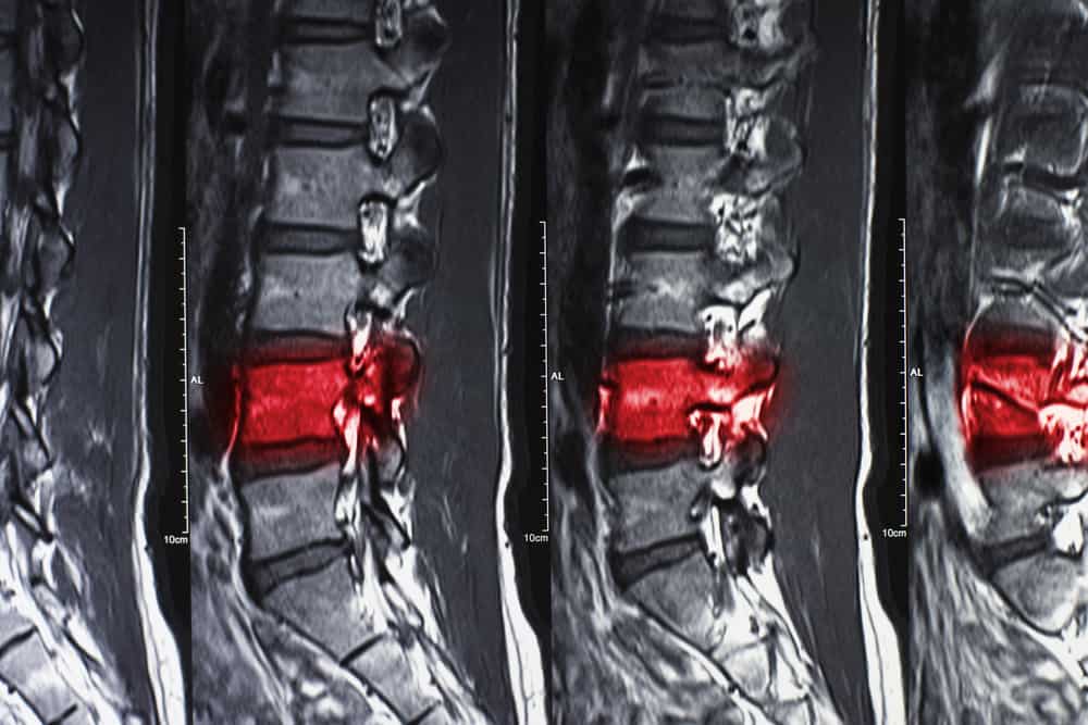 spinal cord injury lawyer edmonton